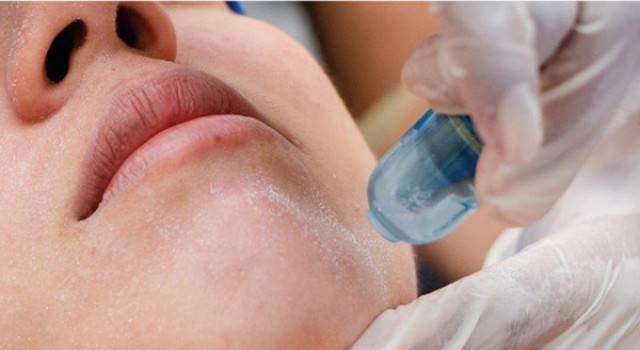 microdermabrasion at Bliss MediSpa