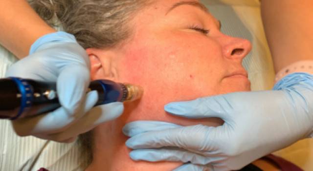 Microneedling